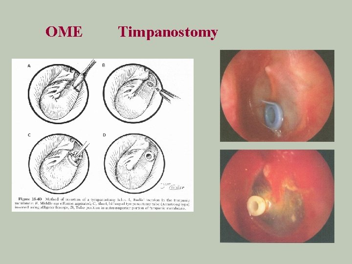 OME Timpanostomy 