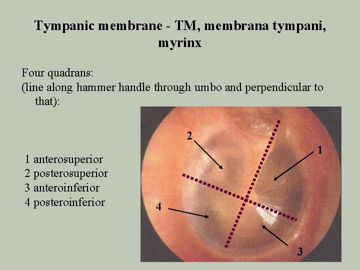 Tympanic membrane - TM, membrana tympani, myrinx Four quadrans: (line along hammer handle through