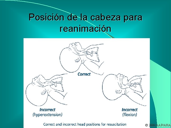 Posición de la cabeza para reanimación © 2000 AAP/AHA 