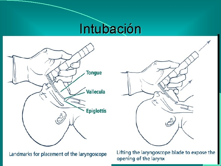 Intubación 
