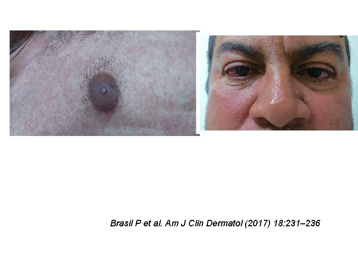 Brasil P et al. Am J Clin Dermatol (2017) 18: 231– 236 