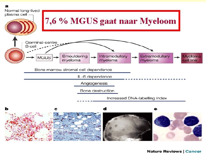 7, 6 % MGUS gaat naar Myeloom 7, 6 % MGUS gaat naar Myeloom