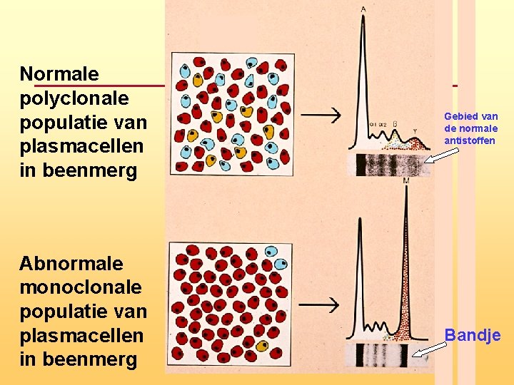 Normale polyclonale populatie van plasmacellen in beenmerg Abnormale monoclonale populatie van plasmacellen in beenmerg Normale polyclonale populatie van plasmacellen in beenmerg Abnormale monoclonale populatie van plasmacellen in beenmerg