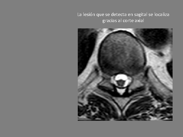 La lesión que se detecta en sagital se localiza gracias al corte axial 