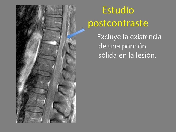 Estudio postcontraste Excluye la existencia de una porción sólida en la lesión. 