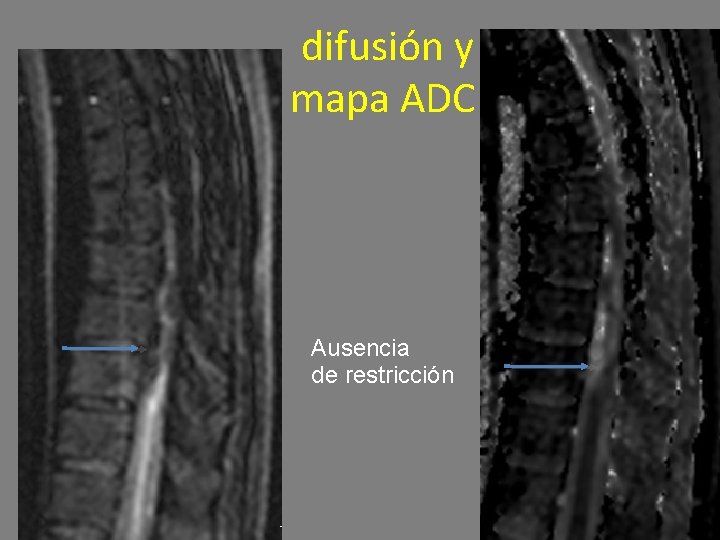 difusión y mapa ADC Ausencia de restricción 