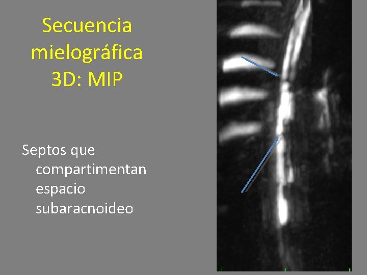 Secuencia mielográfica 3 D: MIP Septos que compartimentan espacio subaracnoideo 