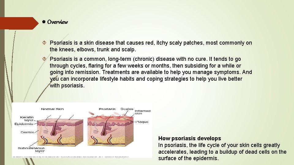 ● Overview Psoriasis is a skin disease that causes red, itchy scaly patches, most