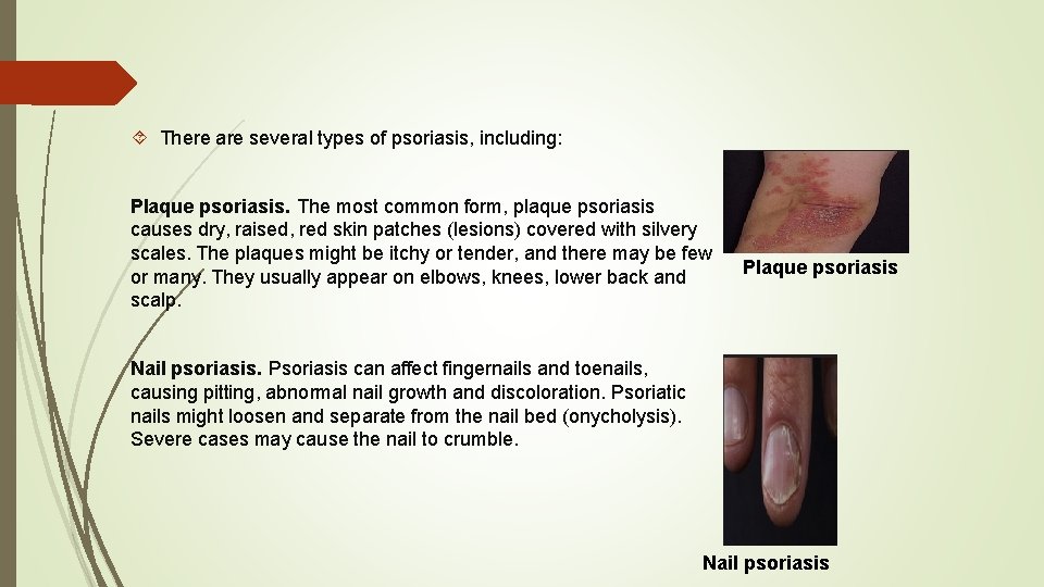  There are several types of psoriasis, including: Plaque psoriasis. The most common form,