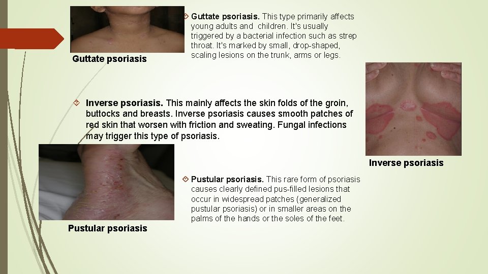 Guttate psoriasis Guttate psoriasis. This type primarily affects young adults and children. It's usually