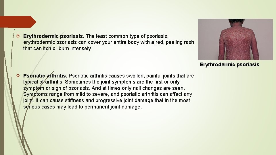 Erythrodermic psoriasis. The least common type of psoriasis, erythrodermic psoriasis can cover your Erythrodermic psoriasis. The least common type of psoriasis, erythrodermic psoriasis can cover your