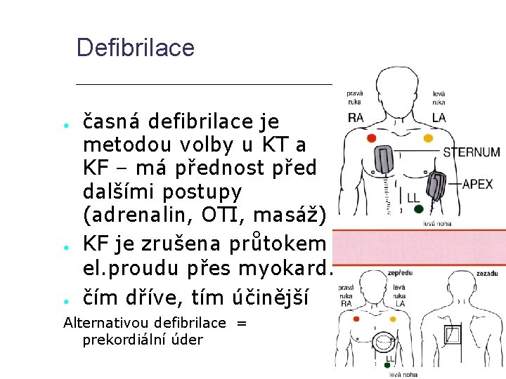Defibrilace ● ● ● časná defibrilace je metodou volby u KT a KF –