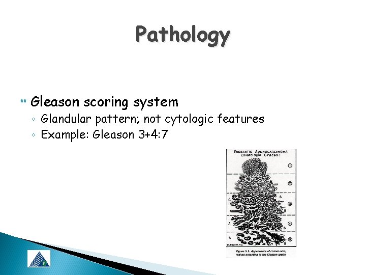 Pathology Gleason scoring system ◦ Glandular pattern; not cytologic features ◦ Example: Gleason 3+4: