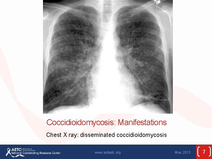 Coccidioidomycosis: Manifestations Chest X ray: disseminated coccidioidomycosis www. aidsetc. org May 2013 7 