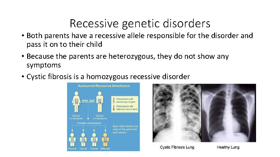 Recessive genetic disorders • Both parents have a recessive allele responsible for the disorder