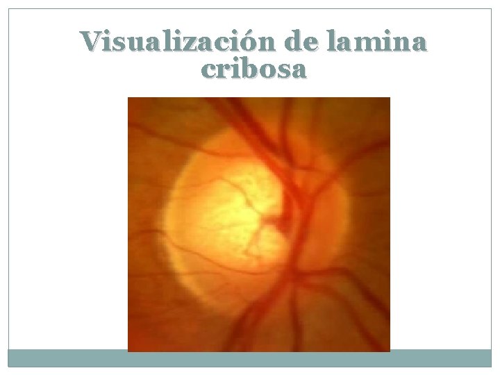 Visualización de lamina cribosa 