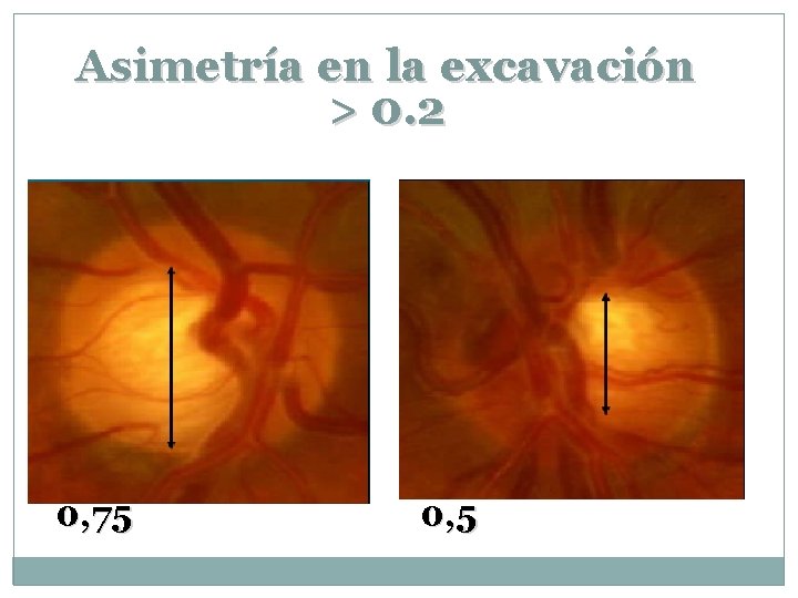 Asimetría en la excavación > 0. 2 0, 75 0, 5 