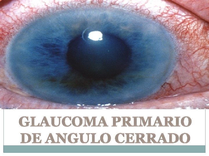 GLAUCOMA PRIMARIO DE ANGULO CERRADO 