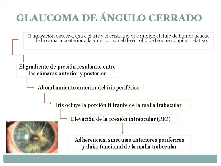 GLAUCOMA DE ÁNGULO CERRADO � Aposición excesiva entre el iris y el cristalino que