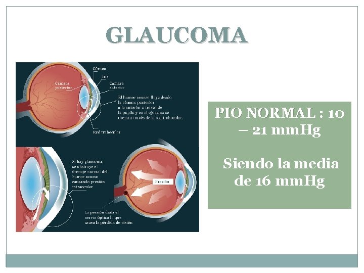 GLAUCOMA PIO NORMAL : 10 – 21 mm. Hg Siendo la media de 16