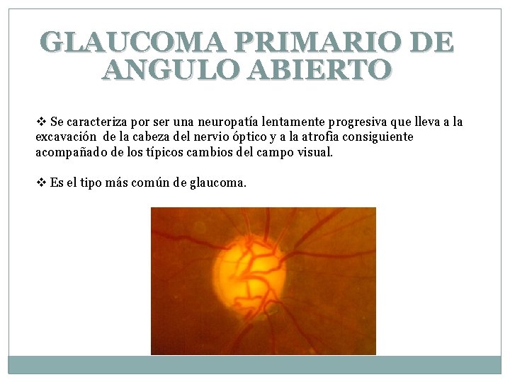 GLAUCOMA PRIMARIO DE ANGULO ABIERTO v Se caracteriza por ser una neuropatía lentamente progresiva