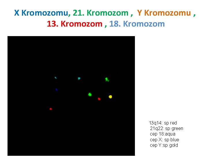 X Kromozomu, 21. Kromozom , Y Kromozomu , 13. Kromozom , 18. Kromozom 13