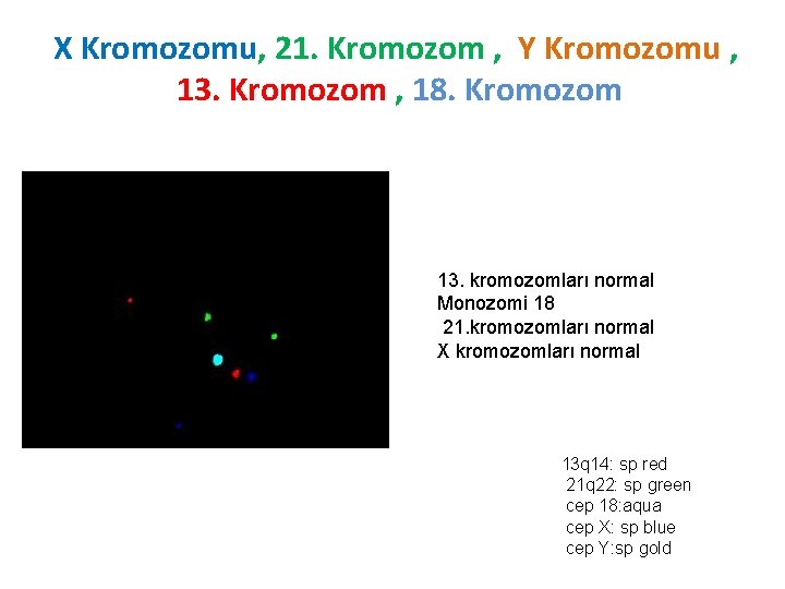 X Kromozomu, 21. Kromozom , Y Kromozomu , 13. Kromozom , 18. Kromozom 13.