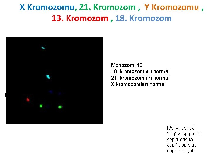 X Kromozomu, 21. Kromozom , Y Kromozomu , 13. Kromozom , 18. Kromozom Monozomi
