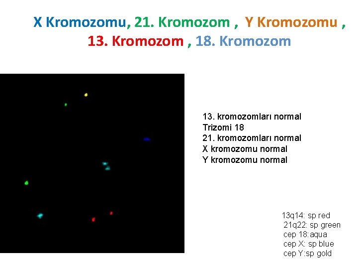 X Kromozomu, 21. Kromozom , Y Kromozomu , 13. Kromozom , 18. Kromozom 13.