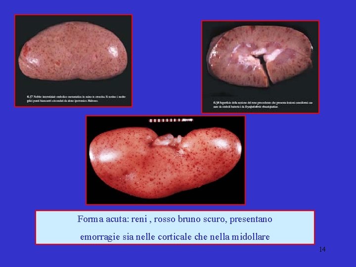 Forma acuta: reni , rosso bruno scuro, presentano emorragie sia nelle corticale che nella