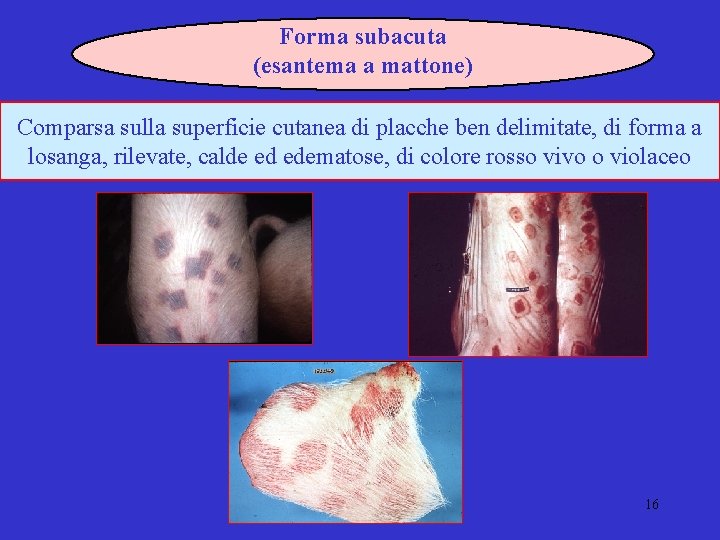 Forma subacuta (esantema a mattone) Comparsa sulla superficie cutanea di placche ben delimitate, di