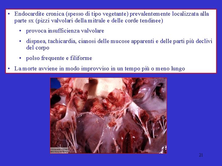  • Endocardite cronica (spesso di tipo vegetante) prevalentemente localizzata alla parte sx (pizzi