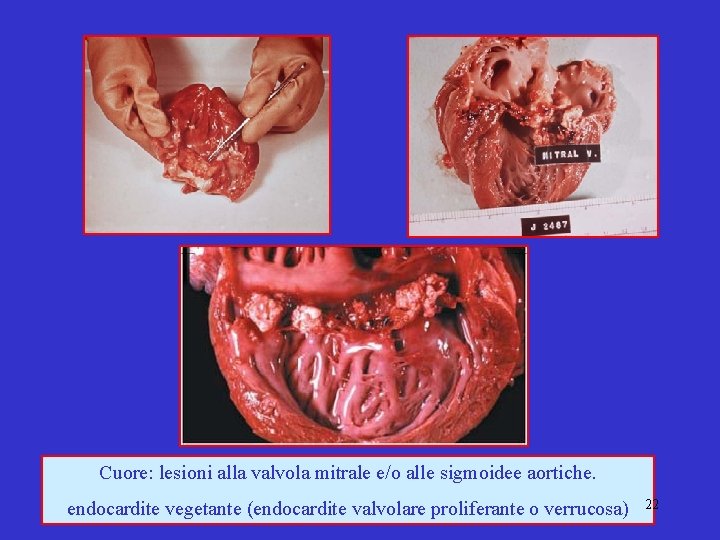 Cuore: lesioni alla valvola mitrale e/o alle sigmoidee aortiche. endocardite vegetante (endocardite valvolare proliferante