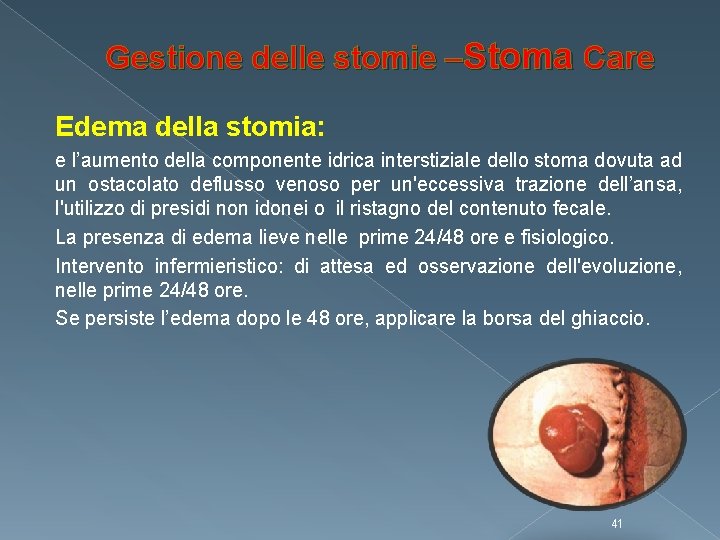 Gestione delle stomie –Stoma Care Edema della stomia: e l’aumento della componente idrica interstiziale