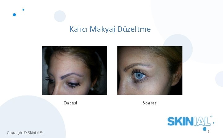 Kalıcı Makyaj Düzeltme Öncesi Copyright © Skinial ® Sonrası 9 