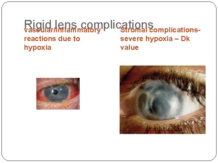 Rigid lens complications Stromal complications- vascular/inflammatory reactions due to hypoxia severe hypoxia – Dk