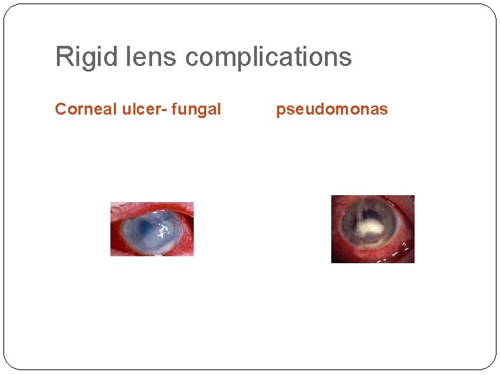 Rigid lens complications Corneal ulcer- fungal pseudomonas 