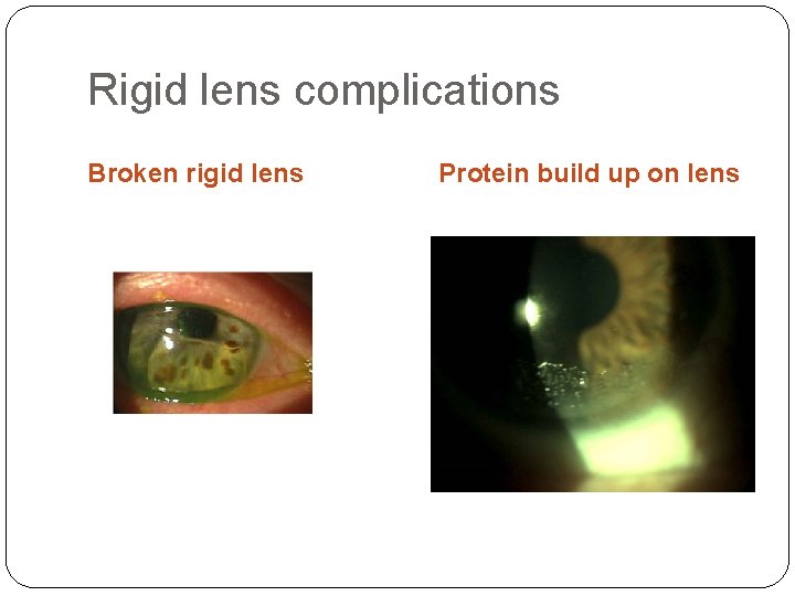 Rigid lens complications Broken rigid lens Protein build up on lens 