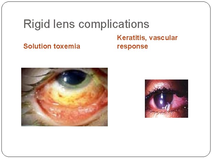 Rigid lens complications Solution toxemia Keratitis, vascular response 