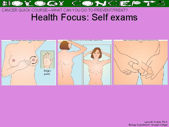 CANCER QUICK COURSE—WHAT CAN YOU DO TO PREVENT/TREAT? Health Focus: Self exams Larry M.