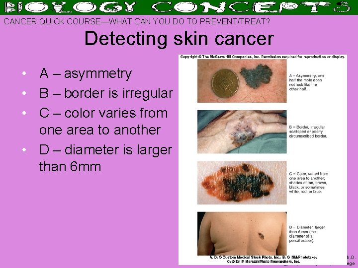 CANCER QUICK COURSE—WHAT CAN YOU DO TO PREVENT/TREAT? Detecting skin cancer • A –