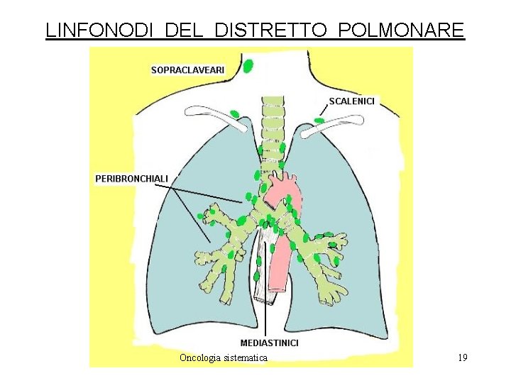 LINFONODI DEL DISTRETTO POLMONARE Oncologia sistematica 19 