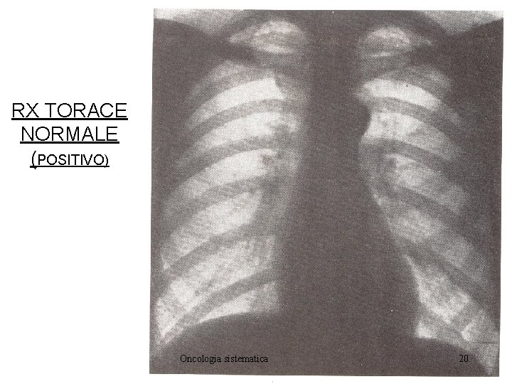 RX TORACE NORMALE (POSITIVO) Oncologia sistematica 20 