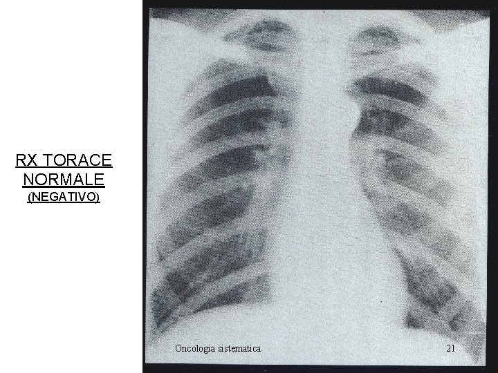 RX TORACE NORMALE (NEGATIVO) Oncologia sistematica 21 