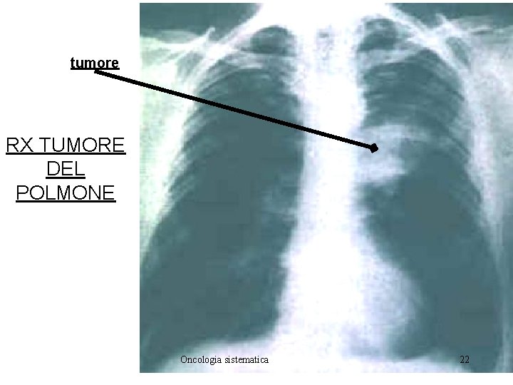 tumore RX TUMORE DEL POLMONE Oncologia sistematica 22 