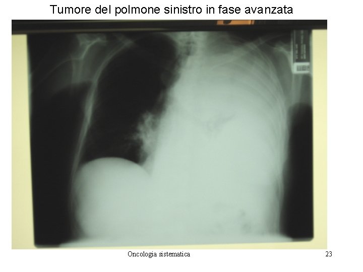 Tumore del polmone sinistro in fase avanzata Oncologia sistematica 23 