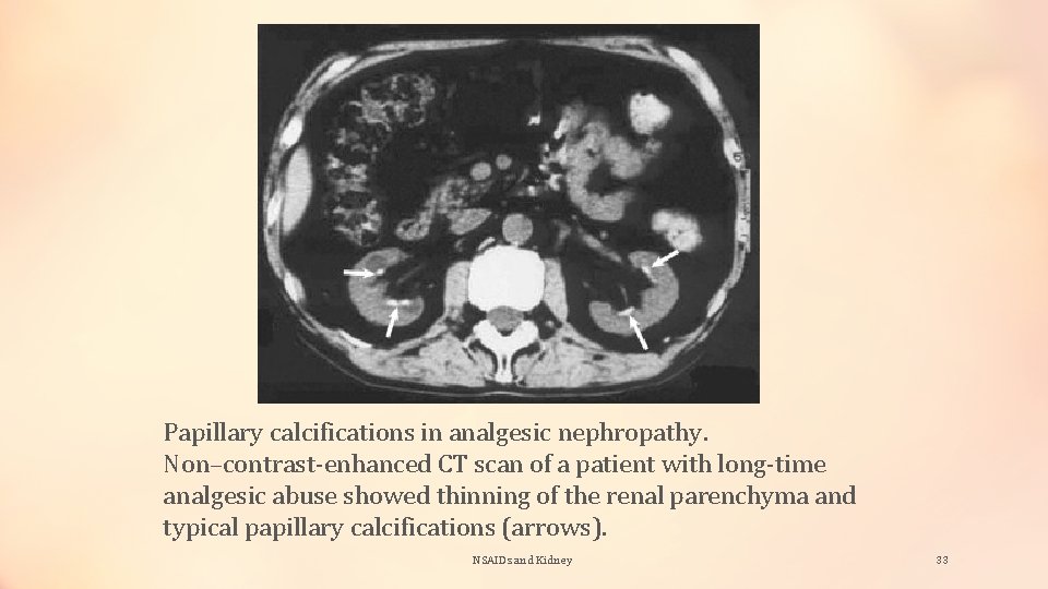 Papillary calcifications in analgesic nephropathy. Non–contrast-enhanced CT scan of a patient with long-time analgesic