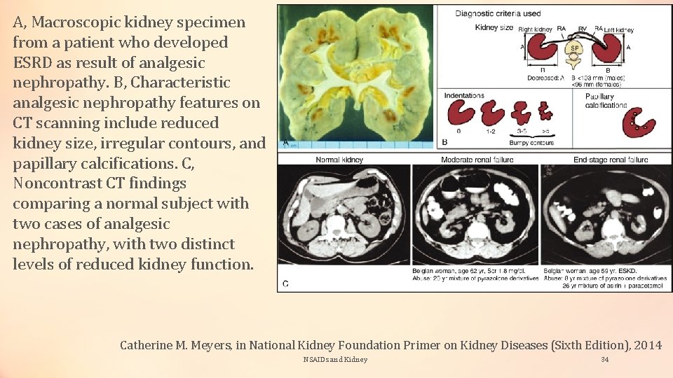 A, Macroscopic kidney specimen from a patient who developed ESRD as result of analgesic