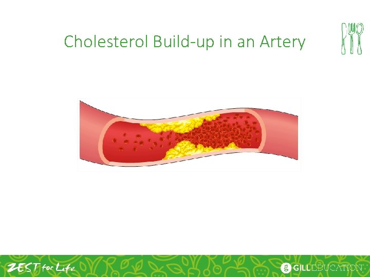 Cholesterol Build-up in an Artery 