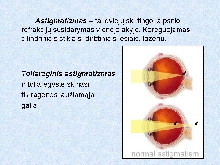 Astigmatizmas – tai dviejų skirtingo laipsnio refrakcijų susidarymas vienoje akyje. Koreguojamas cilindriniais stiklais, dirbtiniais